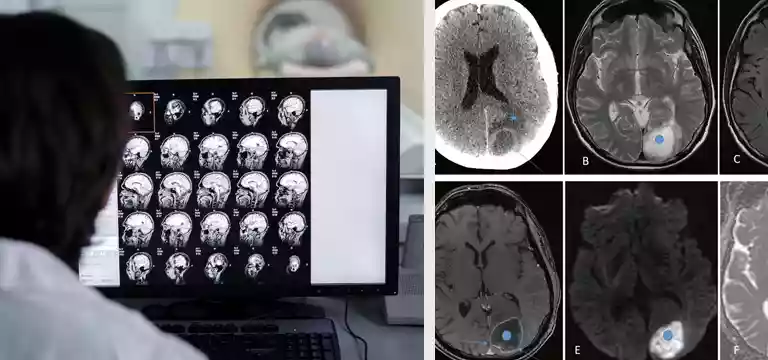 Understanding CT Scans for Neurological Disorders: A Comprehensive Guide